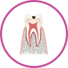 C1 初期の虫歯