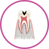 C2 歯の内部まで進行した虫歯
