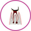 C4 歯の根(歯質)が失われた歯